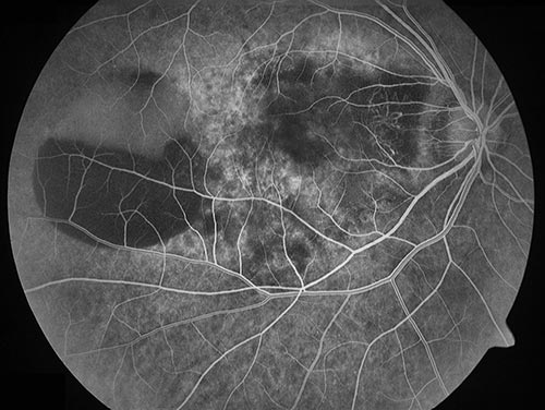 Fluoreszenzangiographie: altersbedingte Makuladegeneration