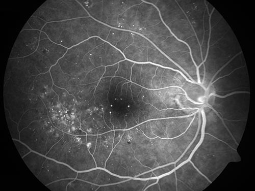 Fluoreszenzangiographie: diabetische Netzthautkrankheit